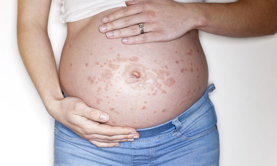 Red Spots On Skin During Pregnancy